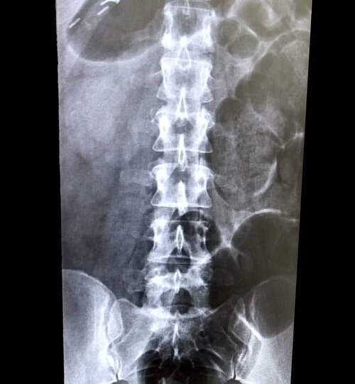an-x-ray-of-a-spine-backbone-vertebrae-from-the-fr-2022-11-14-03-38-17-utc (1) (1) (1)